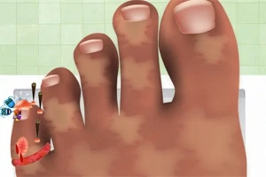 왼쪽 새끼발가락에 못과 상처가 있는 커다란 발 모습